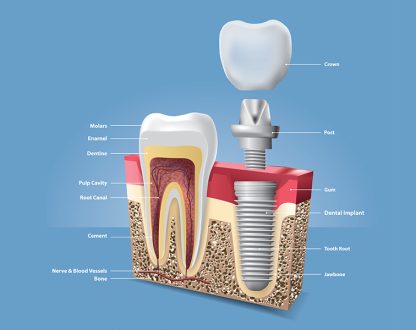 How Dental Implants Preserve Jawbone Health and Prevent Facial Changes