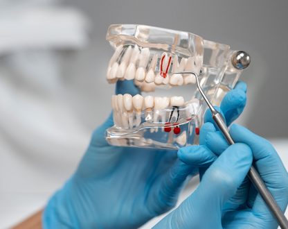 The Top Benefits of Root Canal Therapy: Saving Your Natural Tooth