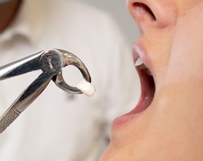 Understanding Tooth Extraction: When It’s the Right Decision?