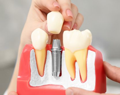 Who Is a Candidate for Dental Implants? Key Factors to Consider