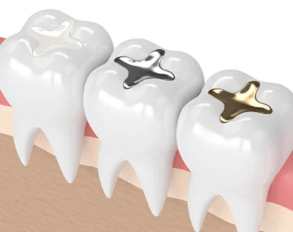 How Long Do Dental Crowns Last? Tips for Maximizing Their Lifespan