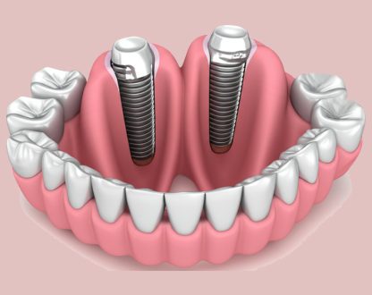 How do Tooth Implants Prevent Bone Loss After Tooth Loss?