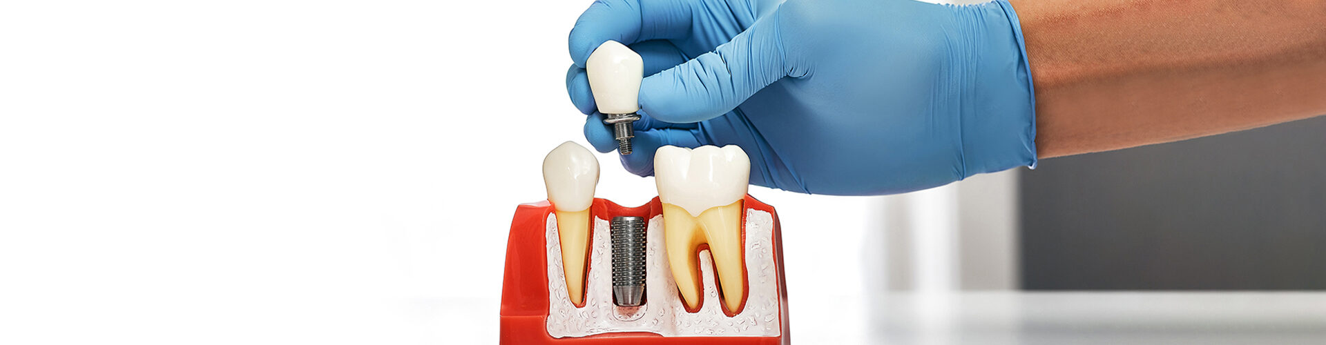 The Optimal Timeframe for Getting Dental Implants After a Tooth Extraction