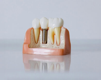 Everything You Need to Know About Dental Implant Abutments