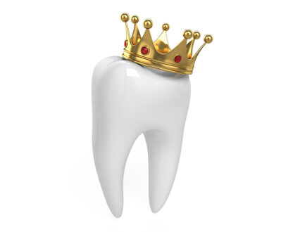 The Process of Getting Front Tooth Crowns: What to Expect