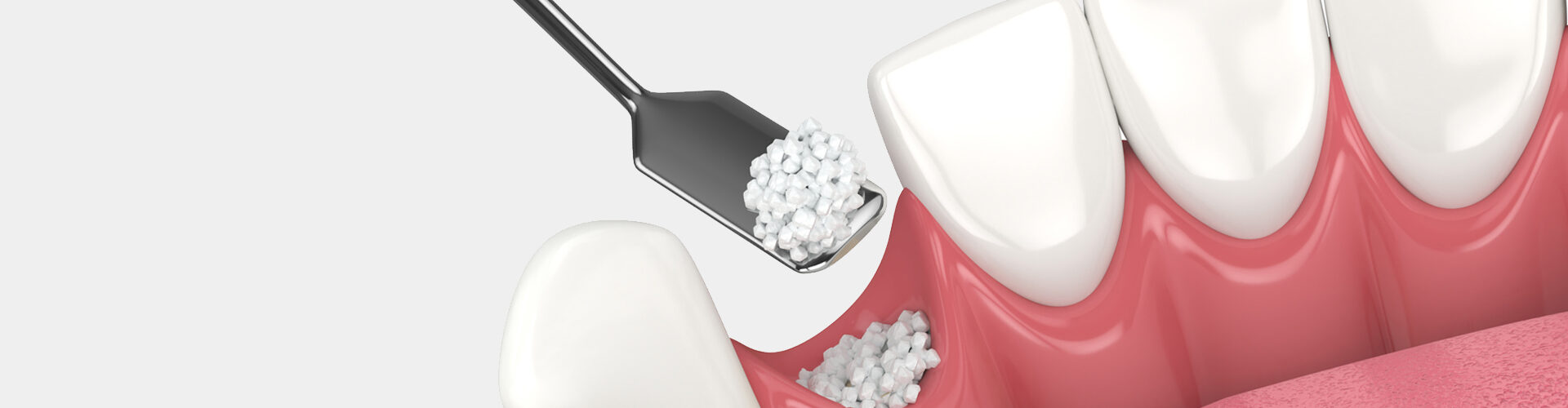 When Bone Grafting Is Essential for Successful Dental Implants