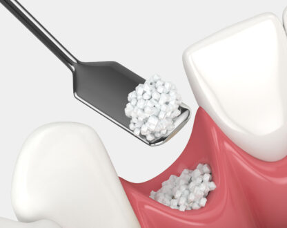 When Bone Grafting Is Essential for Successful Dental Implants