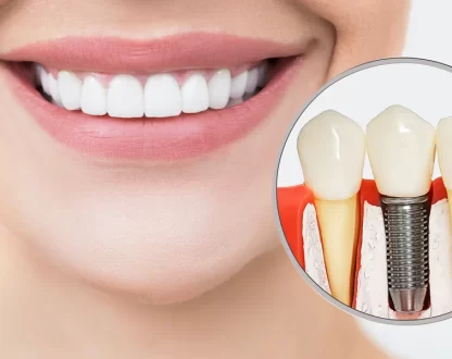 Dental Implants and Gum Recession: Can They Coexist?