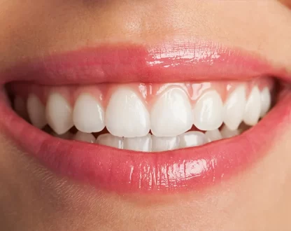 Is Teeth Whitening Safe for Sensitive Teeth?