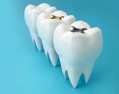 Why Patients Choose Tooth Colored Fillings for Modern Cavity Treatment