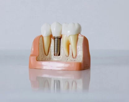 5 Benefits of Choosing Dental Implants for Missing Teeth