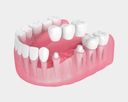 How Dental Bridges Restore Your Smile and Confidence