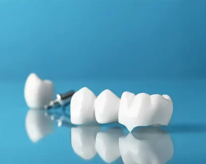 How Dental Crowns in Ohio Help Restore Teeth After Large Fillings Fail